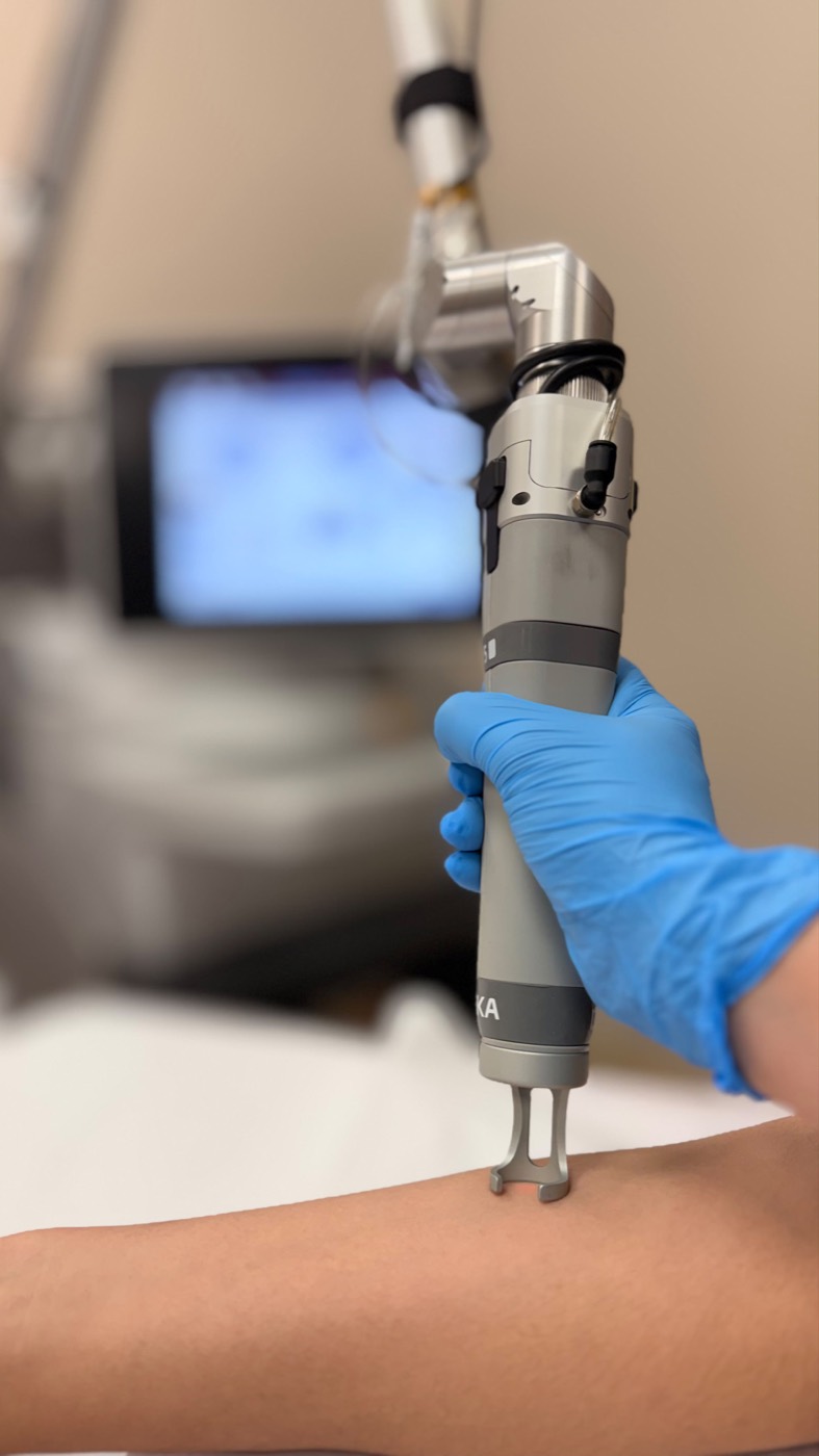 Ponteira do laser SmartPICO da DEKA sendo aplicada, conduzida por profissional com luvas